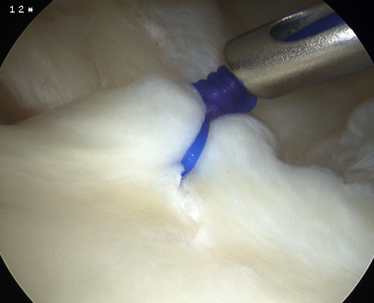 MDI Anterior Capsular Plication 3